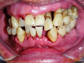 Periodontitis