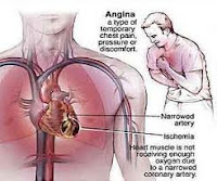 pengertian angina pektoris,pengertian nyeri dada, Blog Keperawatan