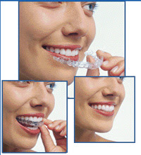 Invisalign