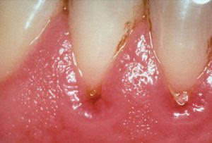 Nguyên nhân gây viêm chân răng có mủ ở trẻ em