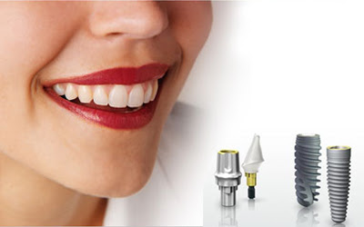 Cách trồng răng Implant