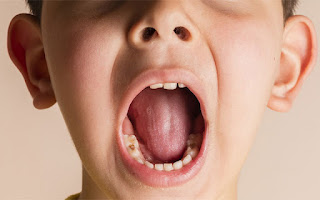 Nguyên nhân và cách chữa nhức răng cho trẻ-2