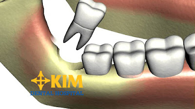 Răng khôn nhổ rồi có mọc lại không?