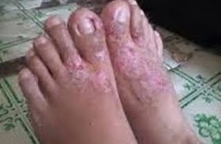 Perawatan Eksim Wajah, gatal eksim Basah (Dermatitis Numularis), Cara Mengatasi Alergi gatal eksim, obat alami kulit gatal eksim, cara mengobati gatal atau eksim, Eksim Basah Adalah, Herbal Penyakit Eksim, Penyakit Kulit Eksim Dermatitis, gatal eksim Kering Salep, Obat gatal eksim Cara Tradisional, Obat gatal eksim Di Kulit Kepala, Mengobati gatal eksim Basah, Obat gatal eksim Pada Payudara, Inerson Eksim, Penyakit gatal eksim Sembuh, Penyakit gatal eksim Pada Kelamin, Masalah Gatal Di Kemaluan Lelaki, Penyakit Kulit Eksim Dan Obatnya, gatal eksim Pada Wanita Hamil, Makalah Penyakit Eksim, Obat Eksim Kulit Untuk Anak, Mengobati gatal eksim Basah Secara Alami, Obat Eksim Basah Ampuh, Obat gatal eksim Kulit Untuk Anak, Mengobati gatal eksim Di Payudara, Obat Eksim Basah Untuk Anak, Penyakit Gatal Gatal Di Kemaluan, Eksim Yang Bernanah 