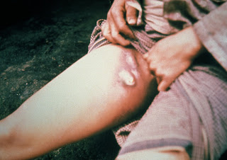 bubón o bubones por peste negra causada por picadura de pulga