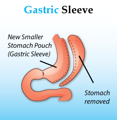 http://www.diabesity.in/laparoscopic-sleeve-gastrectomy