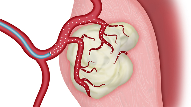 Embolization Market