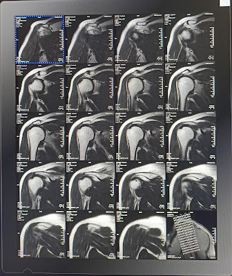 MRI Shoulder joint