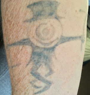 Fading after three picosure and four q-switched laser tattoo removal sessions.