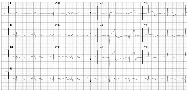 ECG of Acute MI in cocaine abuser