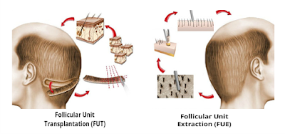 Hair transplant in Navi Mumbai