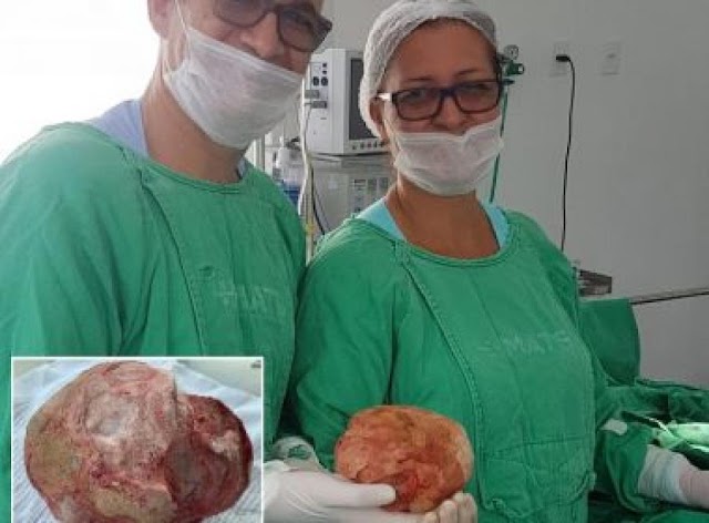 Jacobina: Lavrador de 51 anos tem pedra de 1,3 Kg e 18 cm retirada da bexiga em cirurgia