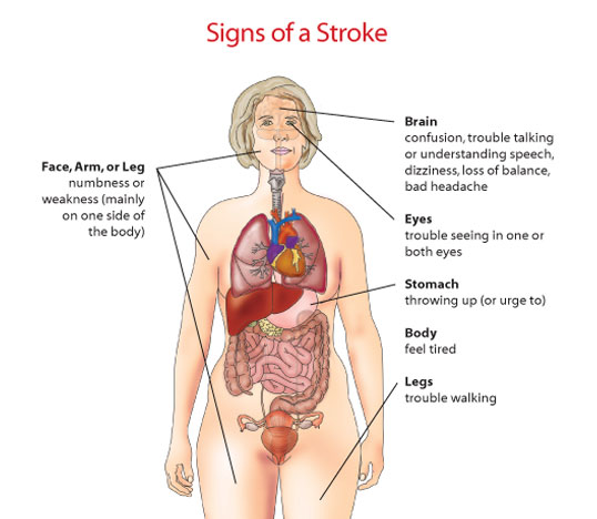 Stroke - Types, Treatments