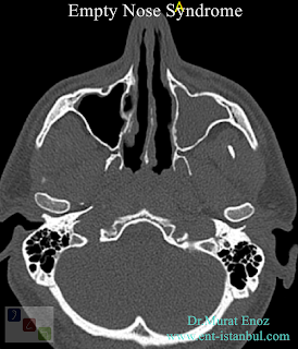 cold turbinate,ENS,Nasal physiology,Empty Nose Syndrome,healthy turbinates,Nasal Hyperventilation,