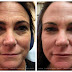 Treatment for Jowls Top Backgrounds