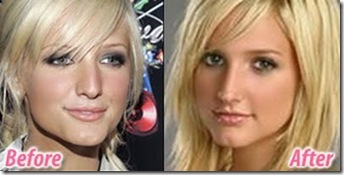 Ashlee Simpson's Very Public Nose Job