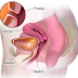 Colovesical fistula - Symptoms, Diagnosis, Surgery, Recovery time