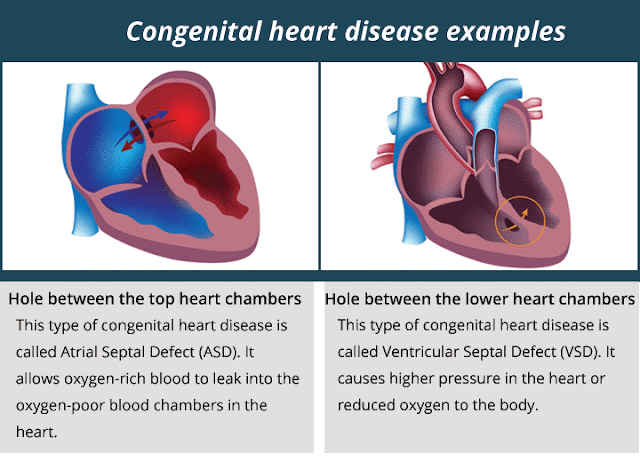 Congenital Heart Desease Example