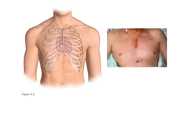 A partial sternotomy gives good exposure of the aortic root and could be selected to reduce the incidence of sternum instability and wound infection.