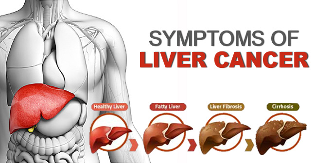 Do probiotics have the potential to forestall the liver cancer