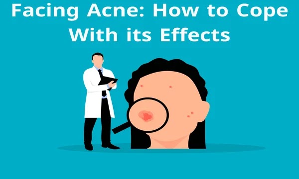Facing Acne-How to Cope With its Effects