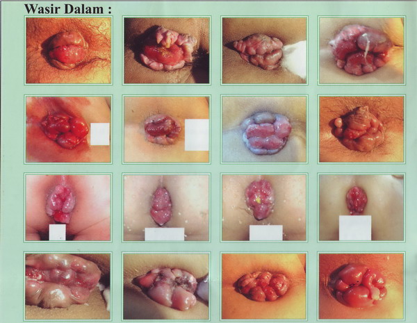 obat wasir di apotik 