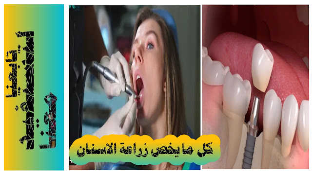 كيف تتم زراعة الاسنان في العيادات،جراحة زراعة الاسنان،تعرف على عيوب و فوائد زراعة الاسنان في شارقة، زراعة الاسنان في دبي من افضل التكنولوجيا،سعر زراعة الاسنان في العين دار زين