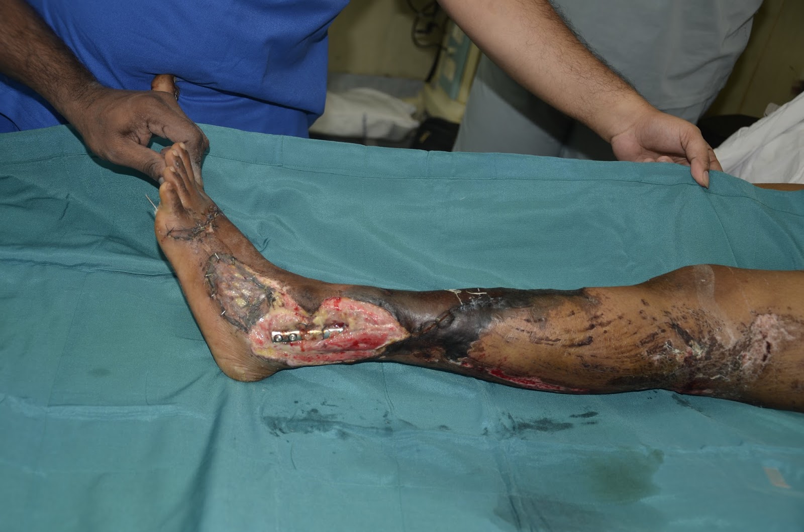 CRUSH INJURY FOOT, LOWER LIMB INJURIES AND LIMB SALVAGE: CRUSH INJURY LEG  WITH BOTH BONE FRACTURE LEG - GRACILSI FREE FLAP FAILURE - NEGATIVE  PRESSURE WOUND THERAPY AND SKIN GRAFTING - OUTCOME