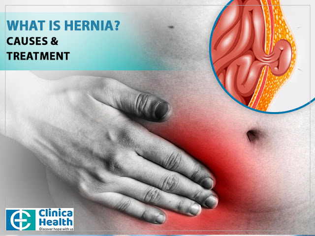 Hernia cause and treatment in kolkata