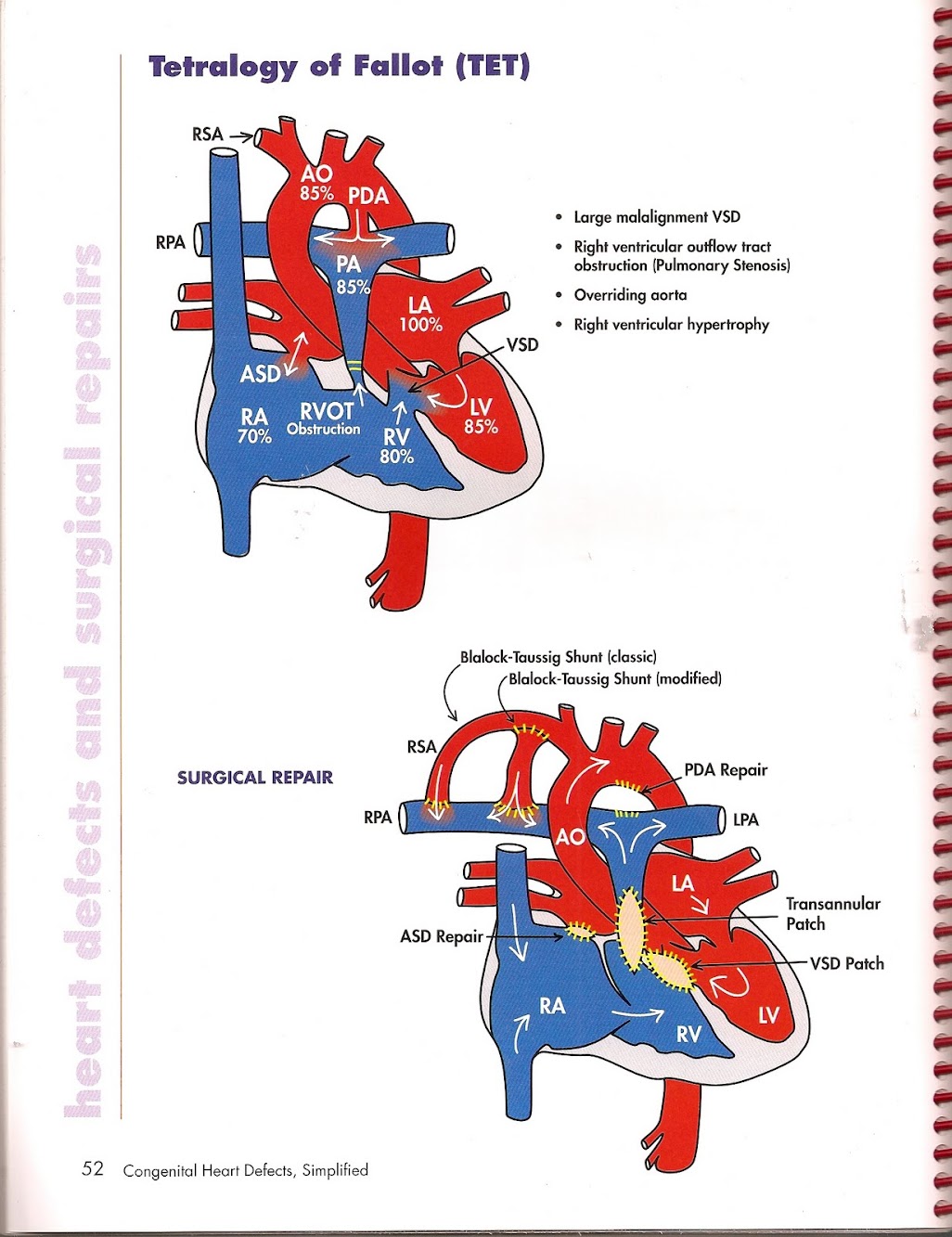 Heart Defects Simplified