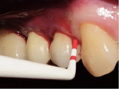 Răng sâu bị chảy máu xử lý thế nào?
