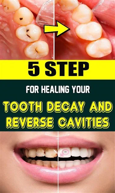 5 Steps For Healing Your Tooth Decay and Reverse Cavities