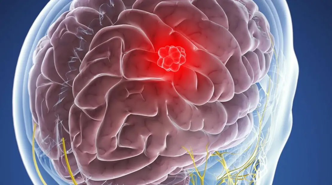 Benign Meningioma Life Expectancy