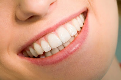 Bọc răng sứ mất bao lâu thời gian?