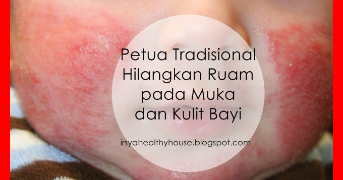 4 Petua Tradisional Hilangkan Ruam pada Muka dan Kulit ...