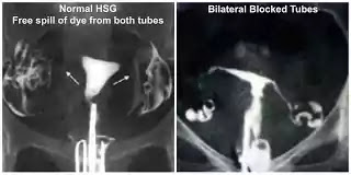 HSG  hysterosalpingography