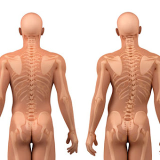 Nursing Diagnosis and Intervention for Scoliosis