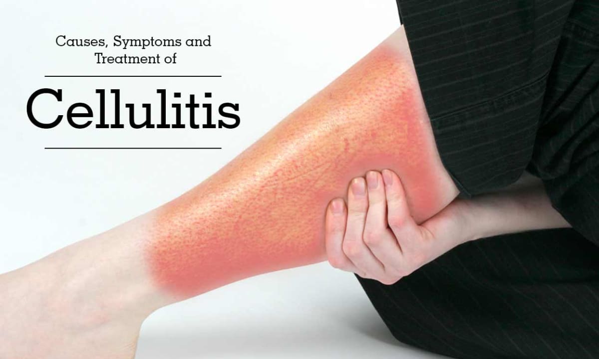 What You Need To Know About Cellulitis Getwell Remedies