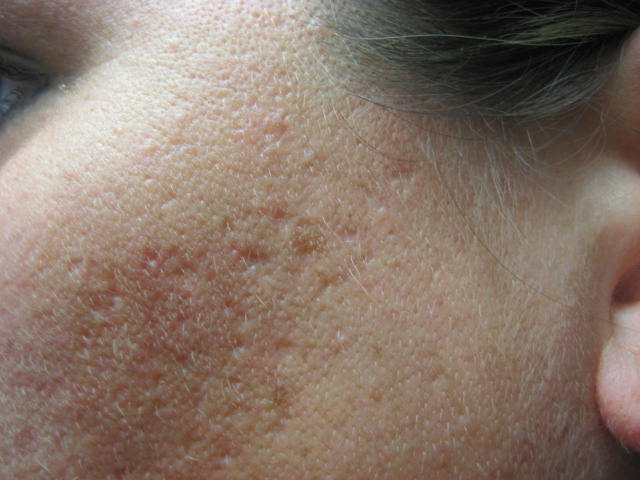 pantothenic acid for pimples
