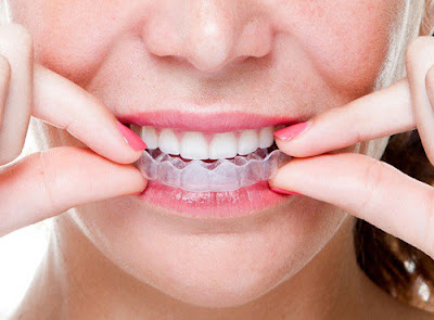 Niềng răng không mắc cài 3D Clear là gì?