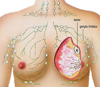 Resep Obat Kanker Payudara herbal, obat kanker payudara alami, pengobatan kanker payudara alami