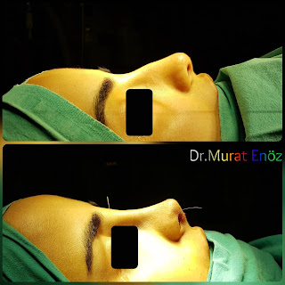 Micromotor Assisted Rhinoplasty, Nose Job Istanbul,Female Nose Aesthetic Turkey,