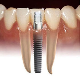 Cheap Dental Implants Melbourne