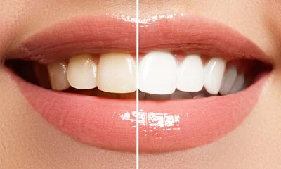 Teeth Whitening In Dubai