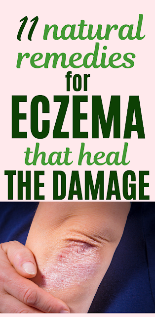 11 Healing Home Remedies for Eczema