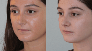 best-nose-plastic-surgery-in-hyderabad