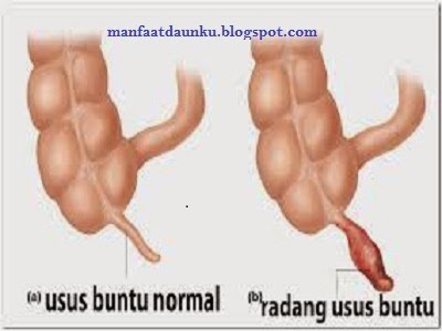 Penyakit Usus Buntu Dan Gejalanya