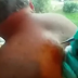 This man wants to get rid of the lump on his back. But when she pricks it, everything comes flying at her.  