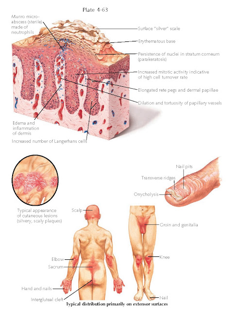 HISTOPATHOLOGICAL FEATURES AND TYPICAL DISTRIBUTION OF PSORIASIS