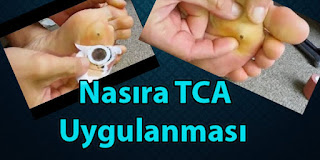 tca nedir ve nasıl kullanılır